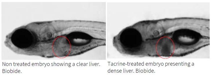 liver opacity